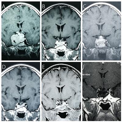 Characteristic of Tumor Regrowth After Gamma Knife Radiosurgery and Outcomes of Repeat Gamma Knife Radiosurgery in Nonfunctioning Pituitary Adenomas